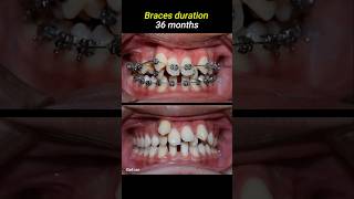 Braces for crowded teeth braces orthodontist dentistry dentist [upl. by Etnahs724]