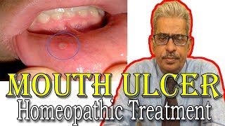 Mouth Ulcer in Hindi  Discussion and Treatment in Homeopathy by Dr PS Tiwari [upl. by Candy518]