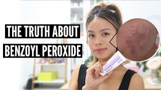 Clear Acne With Benzoyl Peroxide Pros and Cons [upl. by Audris478]