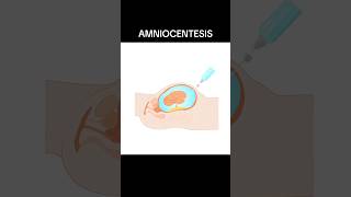 AMNIOCENTESIS amniocentesis  WHAT IS AMNIOCENTESIS shortsviraltrending [upl. by Ajnin]