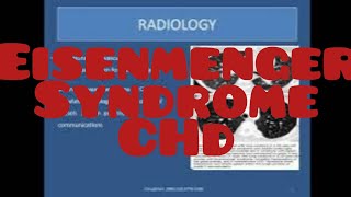 Eisenmenger syndrome  Congenital heart Disease CHD ASD [upl. by Redmund724]