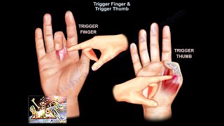 Trigger Finger amp Trigger Thumb  Everything You Need To Know  Dr Nabil Ebraheim [upl. by Tamqrah]