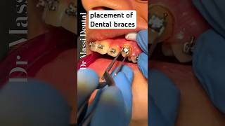 Placement of Dental BRACES Orthodontics [upl. by Etnuahs]