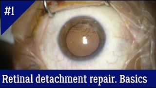 The general principles of vitrectomy for retinal detachment repair [upl. by Lockhart]