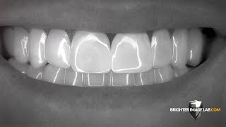 Brighter Image Lab BilVeneers™ The Future of No Dentist Dental Veneers [upl. by Dermott]