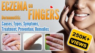 Eczema on Fingers Causes Types Symptoms Treatment and Remedies  Small Blisters and How To Treat [upl. by Hirz]