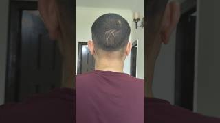 First HairCut After Hair Transplant  Donor area besthairtransplant qht [upl. by Winne]