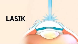 LASIK Surgery and its Risks [upl. by Viviana]