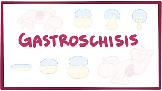 Gastroschisis  an Osmosis Preview [upl. by Mackenie]