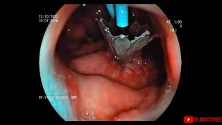 EUS Guided Cystogastrostomy  LAMS 3cm x 14mm with Plastic stent 10 fr x 05cm Placed [upl. by Nosiram]