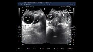 Ultrasound Video showing Rt Ovarian dermoid with Lt ovarian simple cyst [upl. by Goles]