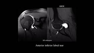 MRI shoulder labrum pathology [upl. by Auhesoj411]