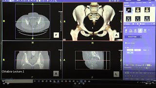 3D Imaging Tutorial Lecture 2 3D Measurements of the Hip Joint  FAI and Dysplasia [upl. by Ten148]