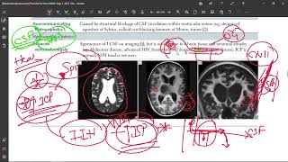 50 Idiopathic Intracranial Hypertension Pseudotumor Cerebri [upl. by Laiceps397]