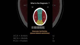 Vascular territories  above lateral ventricles CT Brain Anatomy Quiz 32radiologychannel007 [upl. by Gay92]