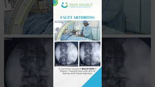 Facet Joint Arthritis is a Common Cause of Back Pain in E lderly painmedics painrelief [upl. by Cairns]