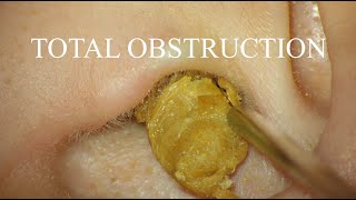 TOTAL OBSTRUCTION  EAR WAX REMOVAL  4KHD [upl. by Nallac60]