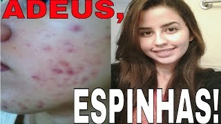 Como me livrei da acne sem Roacutan  O segredo do Peróxido de Benzoíla [upl. by Sperling]