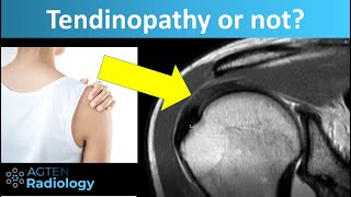 Tendinopathy Tendinosis of Rotator Cuff Tendons on MRI [upl. by Dlaregztif561]