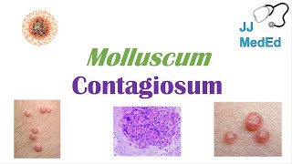 Molluscum Contagiosum “Papules with Belly Buttons” Risk factors Symptoms Diagnosis Treatment [upl. by Panthia]