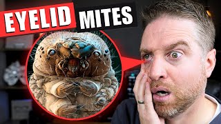 How to Get Rid Of Eyelid Mites That Cause Demodex Blepharitis [upl. by Platon]