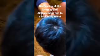 Dislocation of the kneecap and displacement due to a broken ligament [upl. by Yhtamit385]