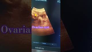 Lower abdomen scan Right ovarian cyst ultrasound usg ovary cystic [upl. by Atonsah]