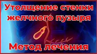 Утолщение стенки желчного пузыря Метод лечения Thickening of the gallbladder wall Treatment method [upl. by Ailliw]