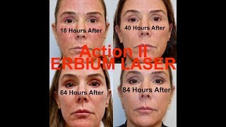 Action II Erbium Laser Resurfacing  Stepbystep procedure start to finish with Dr Weiner [upl. by Esinet]