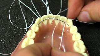 Bonded Retainer following orthodontics treatment [upl. by Enitsenrae411]