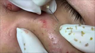 Relax Every Day acne pimplepopping blackheads [upl. by Larok]