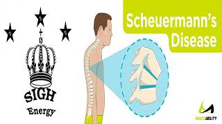 Scheuermanns Kyphosis Healing and Regeneration EXTREMELY POWERFUL Energetically Programmed [upl. by Alledi101]