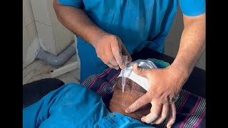 Needle cricothyroidotomy  DrSParthasarathy MD DNB PhD [upl. by Chrystel]