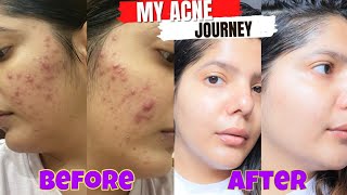 My acne journey that changes my life  How i cleared my skin in 4 months [upl. by Golding]