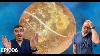 This Earwax Removal Is Unbelievable  EP1006 [upl. by Netsirc]