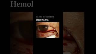 Hemolacria  NEJM [upl. by Eselahs]