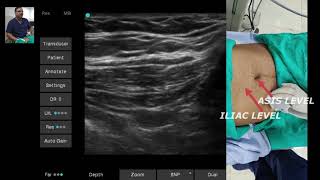 ULTRASOUND GUIDED ILIOINGUINAL amp ILIOHYPOGASTRIC NERVES SONOANATOMY [upl. by Antonino740]