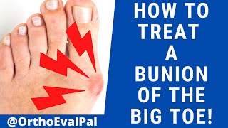 How to Treat a Bunion of the Big Toe [upl. by Soilissav]