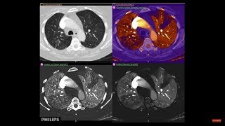 See the world’s first and only detectorbased spectral technology with Philips IQon Spectral CT [upl. by Anniala]