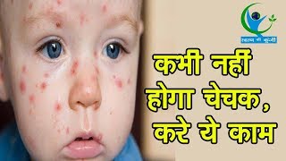 चेचक रोग से बचने के घरेलू उपाय  Smallpox – Chicken Pox – Natural Home Remedies [upl. by Banerjee]