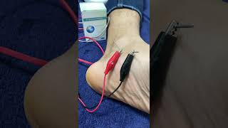 Dry needling  Tendinite de jambier posterieur douleur au pied [upl. by Levine]