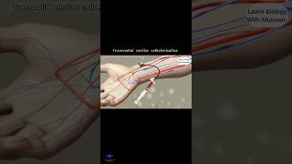 Transradial Cardiac Catheterization  animation shortvideo [upl. by Nirehs]