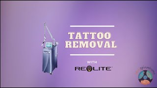 Tattoo Removal using the Revlite Laser [upl. by Notlad]