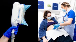 Is CoolSculpting worth it  Before and After Results [upl. by Blatman]