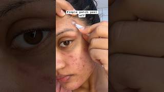 Pimple Patch Removal😱 acne pimplepatch pimplepatches acnepatch acnes acneproneskin pimplepop [upl. by Carry447]