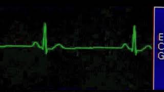 Sinus Bradycardia  Bradicardi Sinusal [upl. by Sandry681]