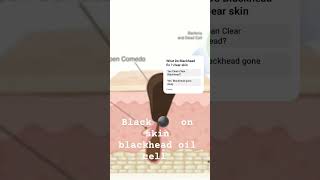 blackheads skincare Blackhead nose 👃 Back head [upl. by Deragon166]