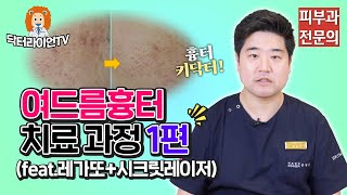 여드름 흉터 레이저 키닥터 피부과✨ 치료 과정 후기 1편 feat 레가또시크릿레이저👀 [upl. by Ransell44]