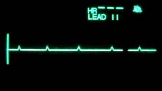 Primary Ventricular Standstill P wave Asystole [upl. by Ainos]