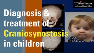 Diagnosis and Treatment of Craniosynostosis in Children [upl. by Nisse688]